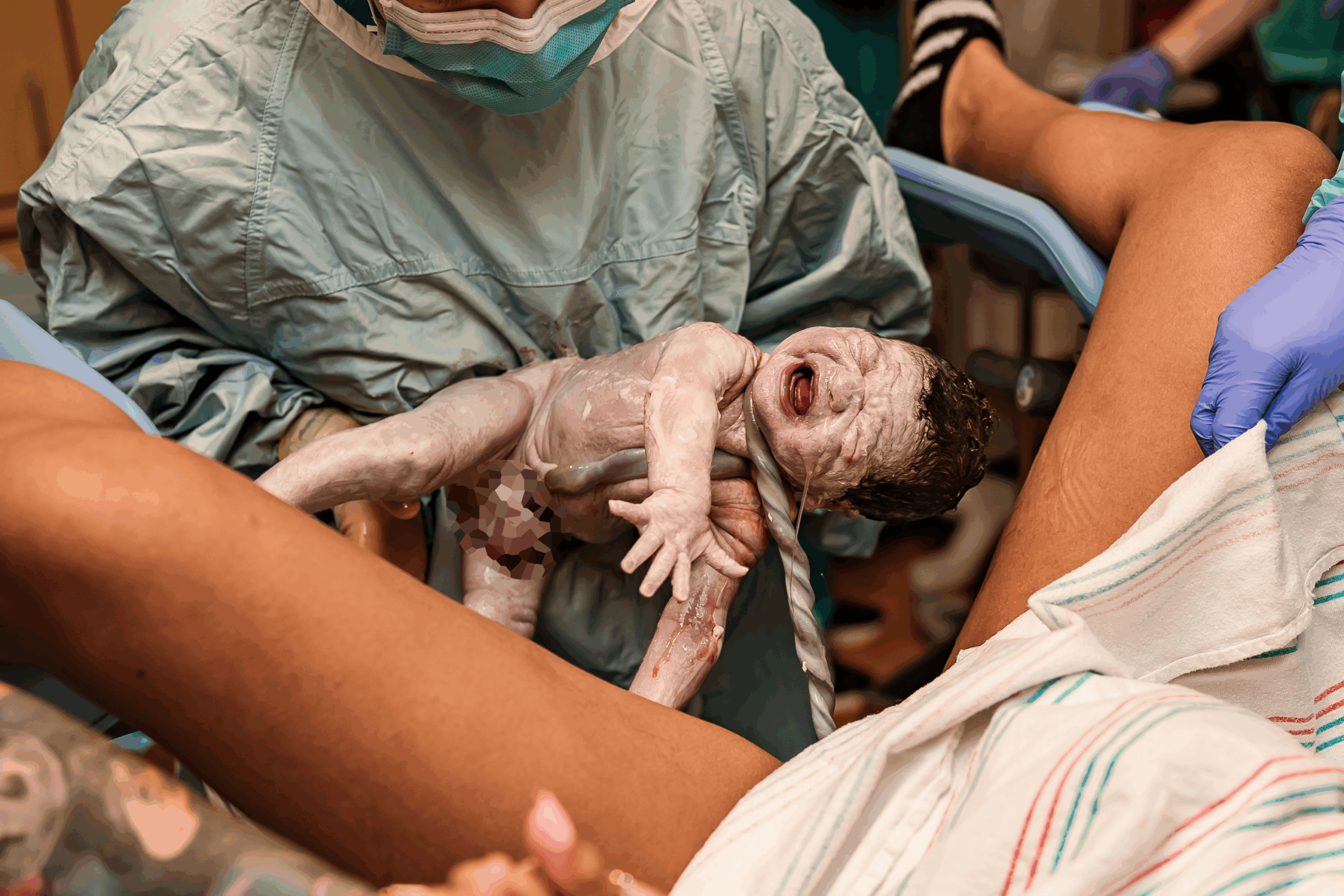 Nuchal Cord